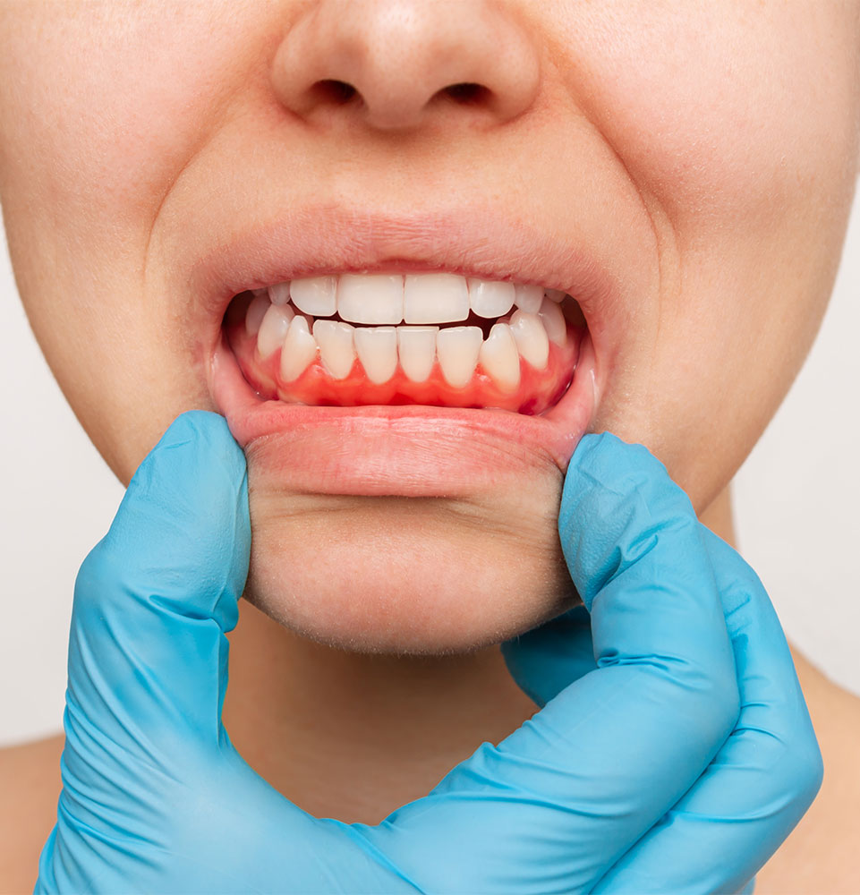 inflamed gums