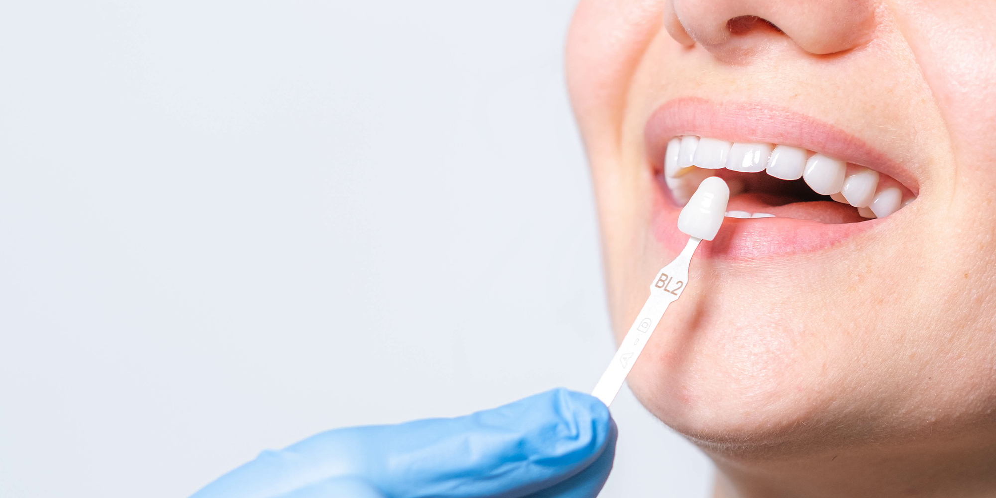 Dentist putting veneers next to patient teeth