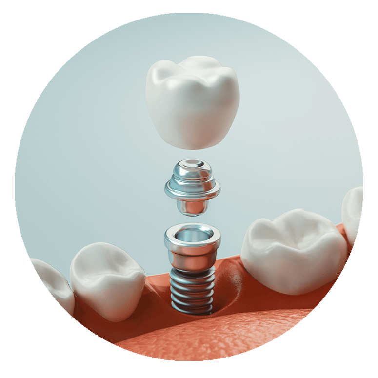 3d model of parts of a implant