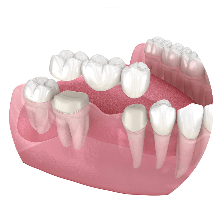 3d model of dental bridge