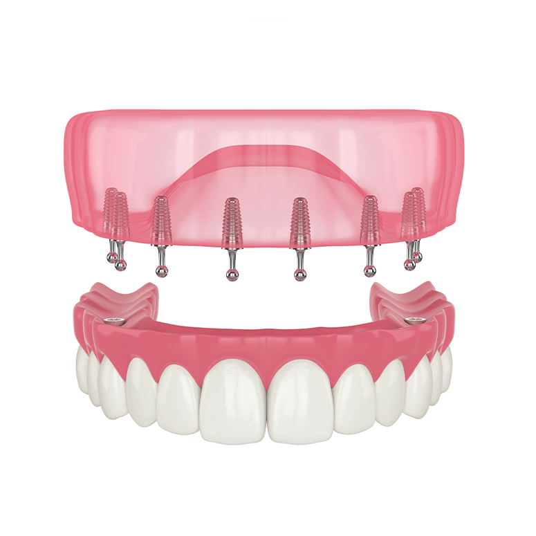 3d model of Snap on dentures