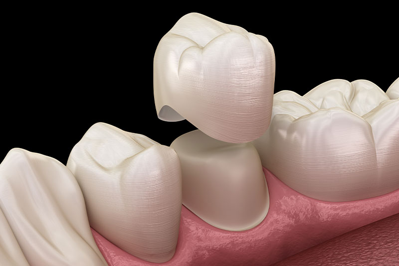 3d model of crowns