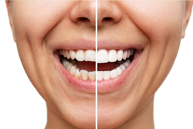 before and after of a veneers