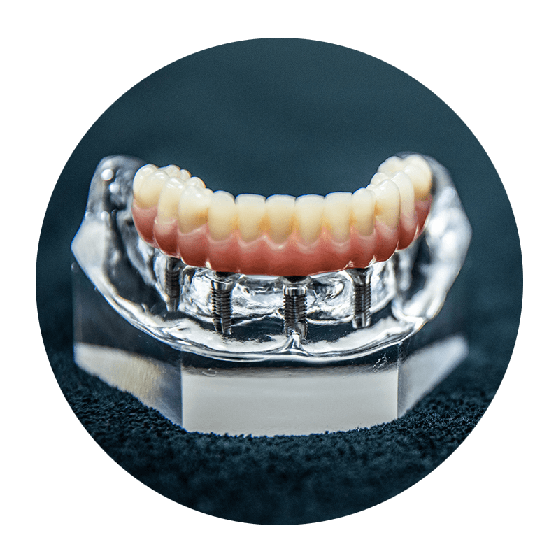 model of implants