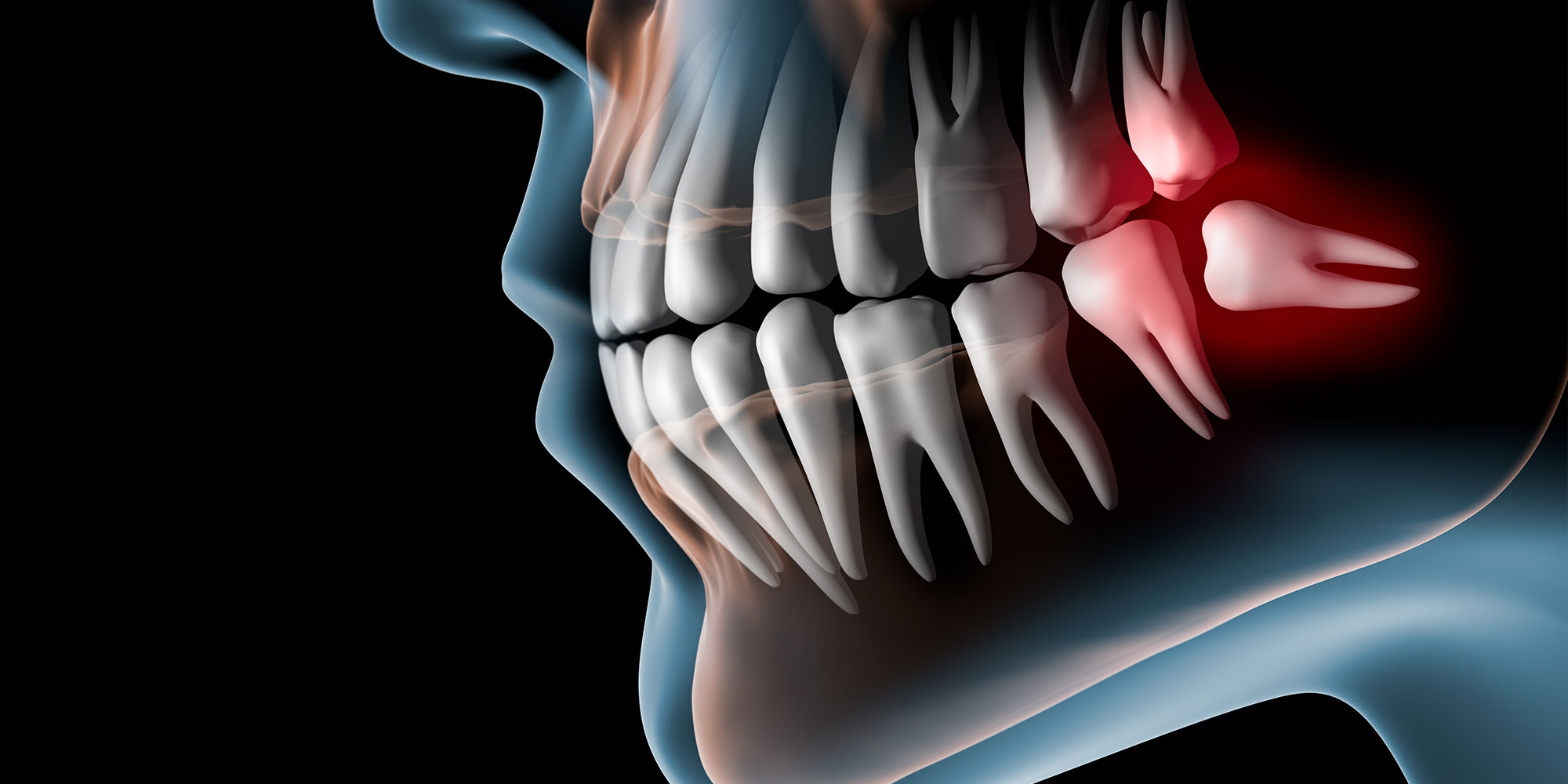 wisdom tooth extraction graphic